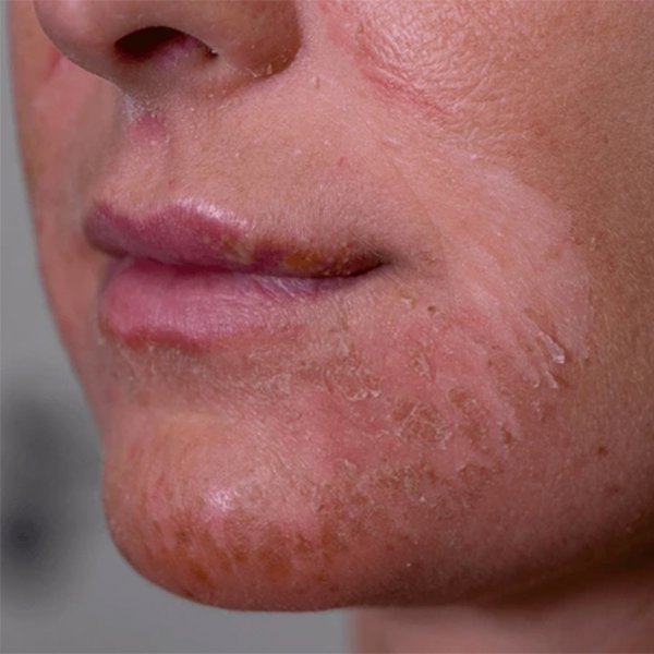 close-dof-lady-damaged-epidermis