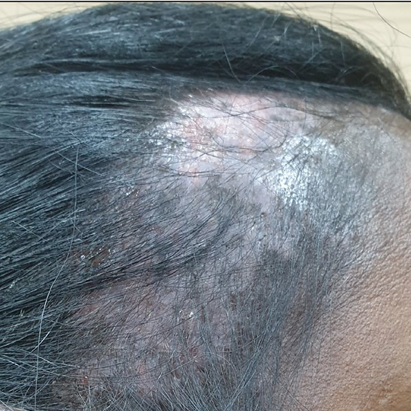 hair color side effect on scalp