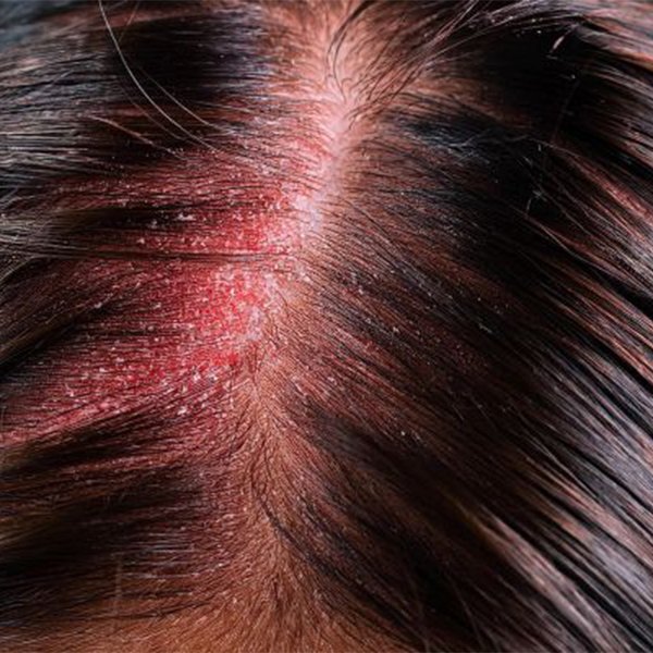 Chemical Hair Color side effect