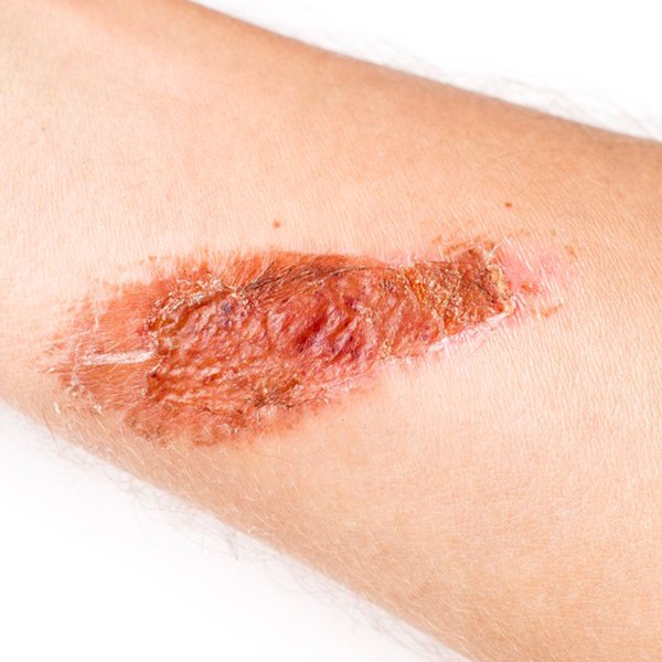 masd-moisture-associated-skin-damage