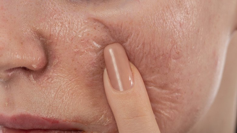 Skin Care Chemicals side effect on face